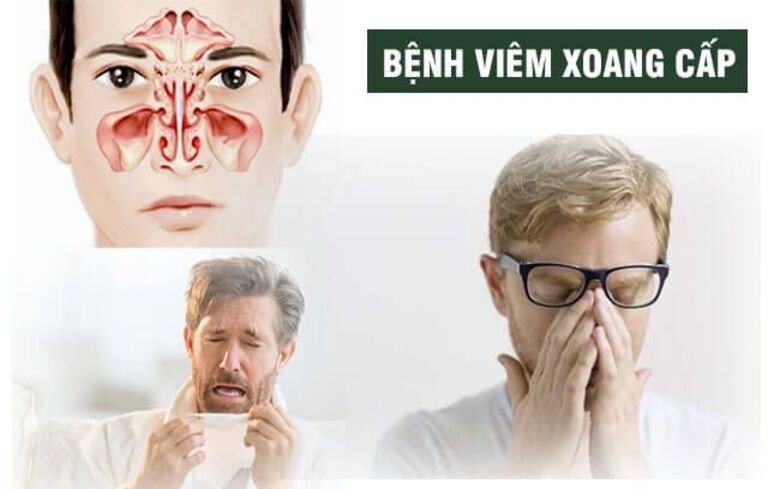 Viêm xoang
